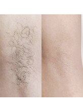 グルーミー(gloomy)/夏に向けて！両脇の脱毛！