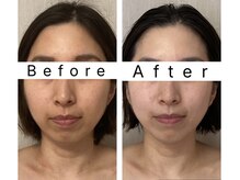 自分史上最高小顔に出会える韓国発コルギ★お顔の歪みもスッキリ