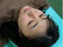 リセット整骨院 布施ほんまち通り院/美容鍼で若々しさを取り戻す♪