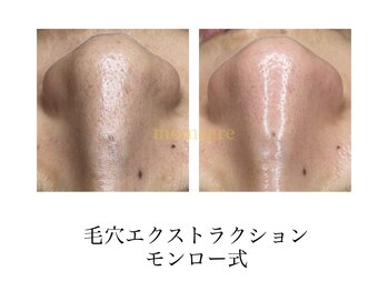 モムケア(momcare)/毛穴エクストラクション