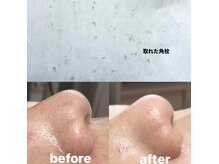 ビューティーネイル(Beauty Nail)/毛穴エクストラクション