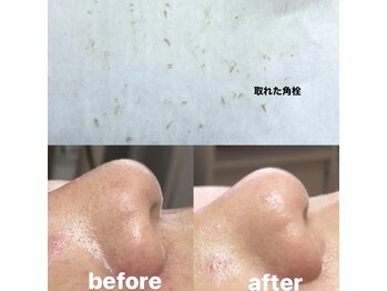 ビューティーネイル(Beauty Nail)/毛穴エクストラクション