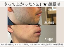 ニコ(Nico)/顔脱毛