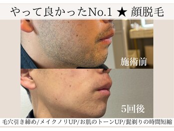 ニコ(Nico)/顔脱毛