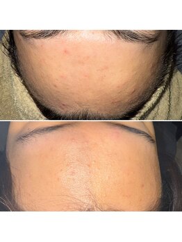 アンベリール(Embellir)/10代の男子中学生「ニキビケア」