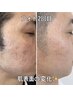 【本気の魅せ肌！】男女大人気の光フォト初回11.000円→2.980円（税込）