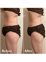 ヴィアージュ(Viage)/脂肪冷却