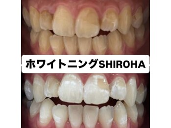 シロハ(SHIROHA)/セルフホワイトニング/天王寺