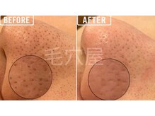 毛穴屋/毛穴洗浄毛穴エクストラクション