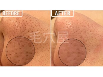 毛穴屋/毛穴洗浄毛穴エクストラクション