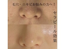 ポリー(Polly)の雰囲気（毛穴 ニキビ/ララピール進化版のセラピール！毛穴洗浄×LDM¥8800）