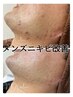 【メンズ限定】メンズエステ/ニキビ改善したい方￥15400→￥12000
