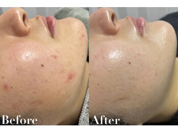 ビジュー(美柔 Bijou)/REVI剥離なしハーブピーリング