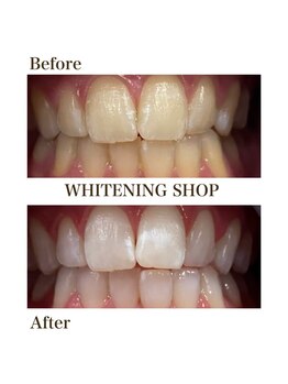 ホワイトニングショップ 岩出店(WHITENINGSHOP)/フリーパスBefore/After