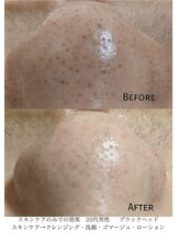 デコアイ(Deco eye)/10代男子　毛穴汚れ