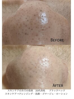 デコアイ(Deco eye)/10代男子 毛穴汚れ