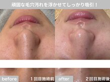 サロン ビュー(salon view)/30代女性〈毛穴黒ずみ悩み〉