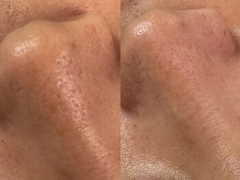 フェリス(FELIZ)/目の下、鼻の毛穴