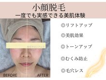 アルゴ 高崎店(ALGO)の雰囲気（顔脱毛で《小顔》!?見ればわかる効果★フォトギャラリーへ）