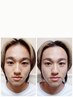 【男性】美眉スタイリング+ハーブピーリング+小顔リフトアップ￥8500