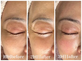 ルー ハナレ 神戸岡本 摂津本山店(Luu HANARE)/くすみ改善　目元凹みケア