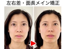 エレヴィザ トウキョウ 恵比寿院(ELVISA TOKYO)/左右差・面長改善 /　初回施術