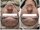ビズビズ(bisebise)の写真/【令和男子は美肌/美肌男子はモテる！】学割U24★長年“くり返す”ニキビケア赤み改善￥7800
