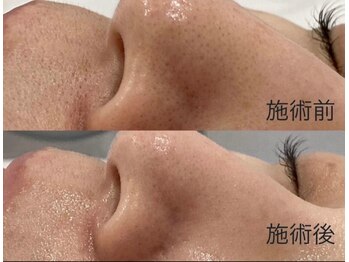 美ネージュの写真/ 【平日15時までがお得！】毛穴洗浄フェイシャル×レモンブースターで毛穴洗浄＆白玉水光肌を同時に実現