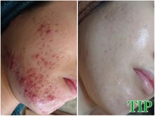 ルノン(Lunon)/肌質改善　《症例》