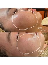 クーラ テュセ(Coeur la Tusais)/角質ケアで気になる跡の改善！