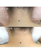 モワメーム(moi meme)/ブライダル脱毛/うなじ脱毛/産毛