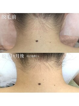 モワメーム(moi meme)/ブライダル脱毛/うなじ脱毛/産毛