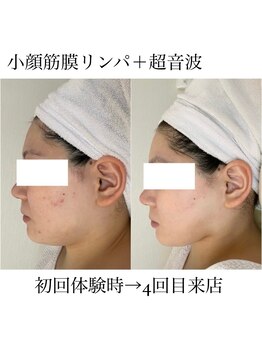 イム(I'm.)/小顔筋膜リンパ+超音波
