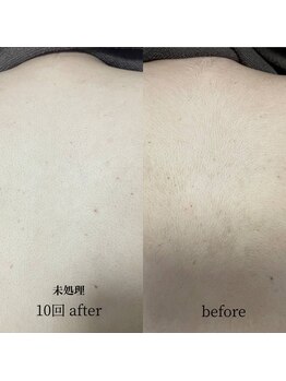 ウィズティ(with.T)/全身脱毛