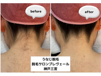 プレヴェール 神戸三宮/うなじ脱毛 襟足脱毛