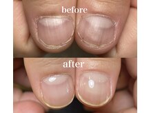 自爪育成メニュー　モニター価格\7700(ホームケアオイル込み)