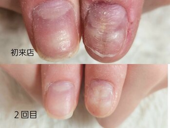 グラシナ なんば店/深爪/自爪育成/フィルイン