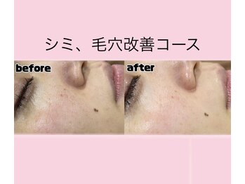 エステティック　レイビス 渋谷店(RAYVIS)/顔脱毛＋シミ毛穴ケア