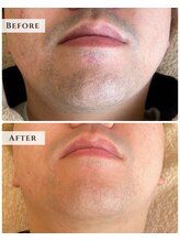 ルアナラウンジ(Luana Lounge)/症例　ヒゲ脱毛