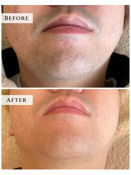 ルアナラウンジ(Luana Lounge)/症例　ヒゲ脱毛