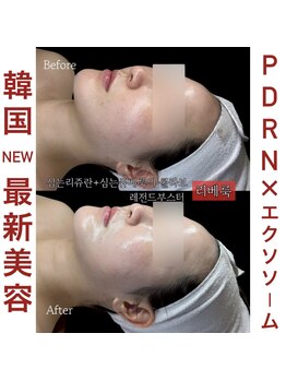 アラベラ(AraBella)の写真/［韓国★最新美容］PDRN×エクソソーム肌育ノンニードル／しっとりとした明るいお肌／毛穴までもっちり