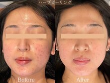 ヒジ(Life Salon)の雰囲気（お顔ハーブピーリング/ニキビケア◎Before /After）