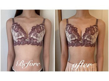 美バストアルファ(美bust α)/【バストアップ】症例