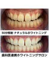 プラチナムビューティ 四条烏丸店(PLATINUM Beauty)/ホワイトニングビフォーアフター