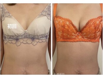 美人バスト 川崎店/バストアップ◇症例◇