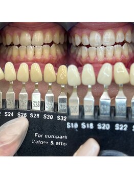 トウキョウスワーズ 池袋店(TOKYO SWRS)/#ホワイトニング #池袋 #渋谷
