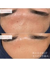 アンドニューリー(&NEWLY)/水玉リフティング　Before After