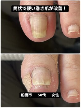 筒状で硬い巻き爪の痛みが改善