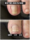 筒状で硬い巻き爪の痛みが改善