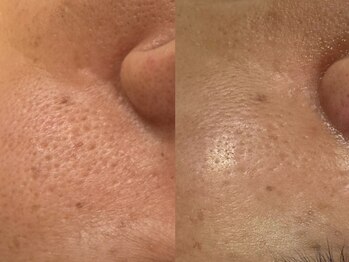 フェリス(FELIZ)/ターンオーバーの促進